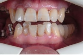 32-dis-implant-fiyatlari