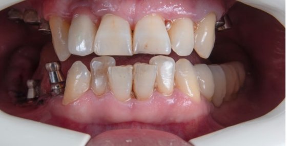 32 Diş İmplant Fiyatları 2025 Yılı Güncel Fiyatlar