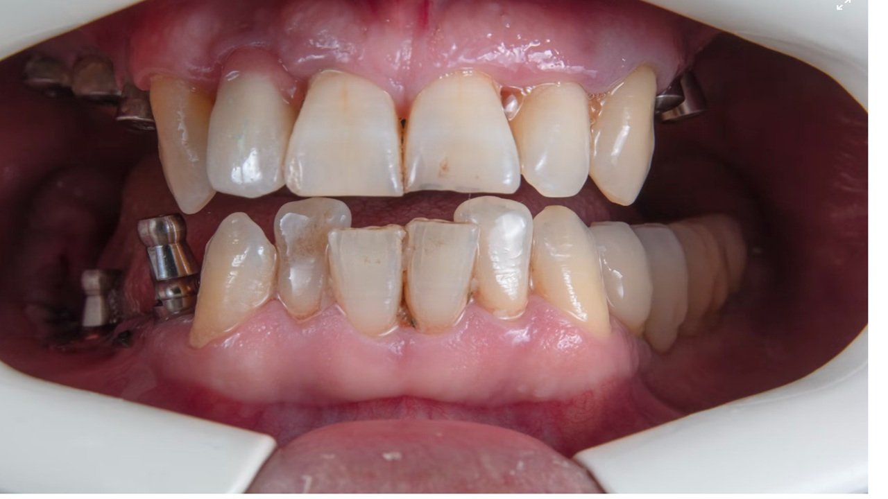 32-dis-implant-fiyatlari