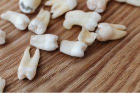 bir-implant-kac-dis-tutar