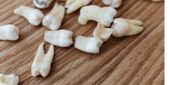 Bir İmplant Kaç Diş Tutar? Hangi Durumlarda Uygulanır?