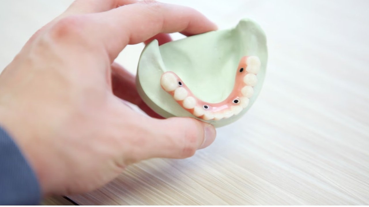 bir-implant-kac-dis-tutar