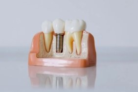 cene-implanti-fiyatlari