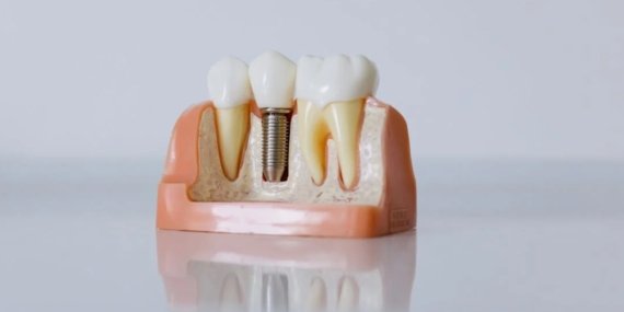 Devlet ve Özel Hastanelerde Çene İmplantı Fiyatları Nasıl?