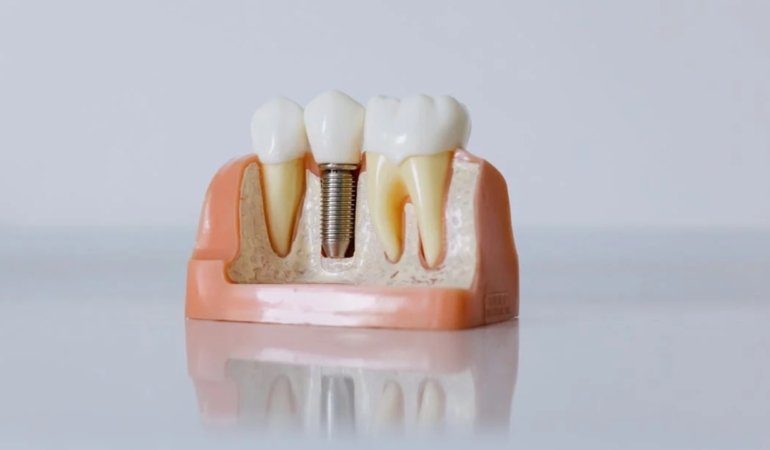 Çene İmplantı Fiyatları