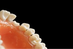 eksik-olan-dis-yerine-ne-yapilabilir