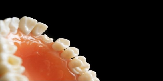 Eksik Olan Diş Yerine Ne Yapılabilir?