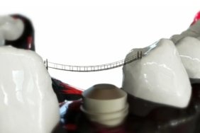 koprulu-implant-nedir