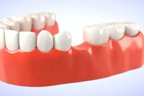 olmayan-dis-yerine-ne-yapilir