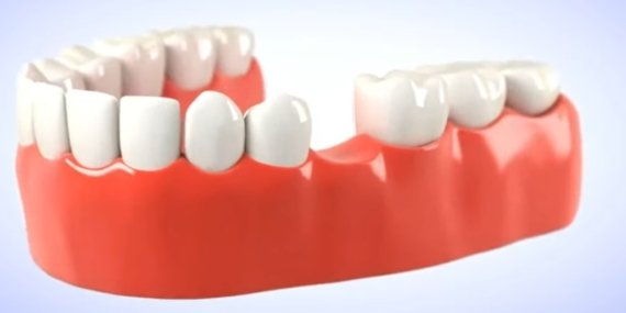 Olmayan Diş Yerine Ne Yapılır? Eksik Dişe Kaplama Olur Mu?