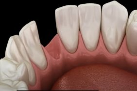 tamamen-dusen-dise-ne-yapilir