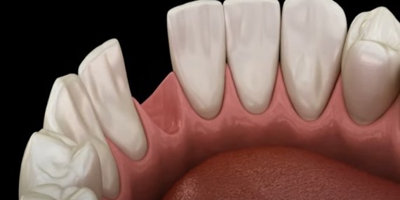 Tamamen Düşen Dişe Ne Yapılır? Tedavisi Nasıl Olur?