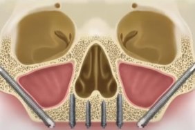 zigoma-implant-fiyatlari