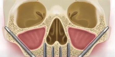 zigoma-implant-fiyatlari