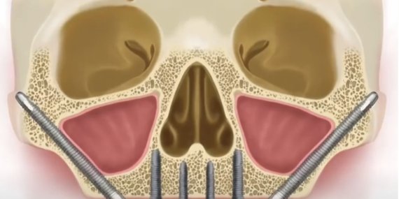 Zigoma İmplant Nedir? Zigoma İmplant Fiyatları 2025