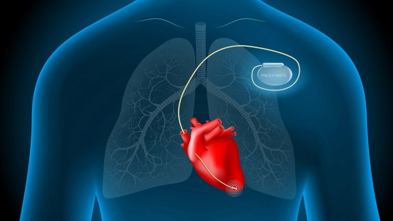 Kalp Pili Nedir, Nasıl Takılır? 3 Başlıkta Kalp Pili Tedavisi