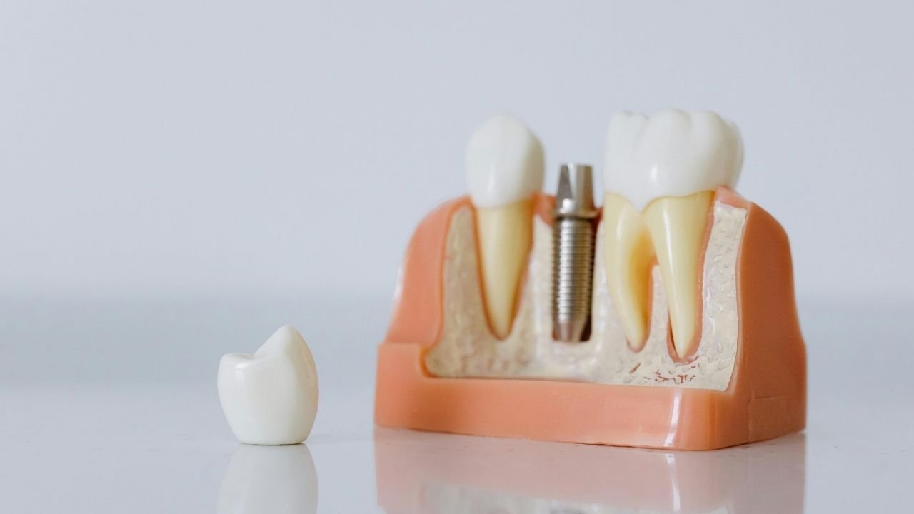 Çene İmplantı Fiyatları